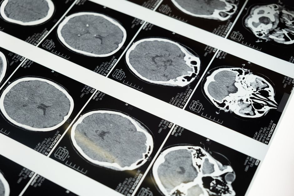 What Your Brain Injury Claim Is Actually Worth