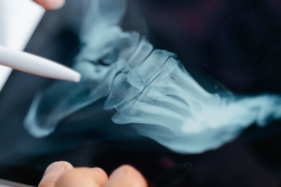 What Broken Bone Settlements Really Cost