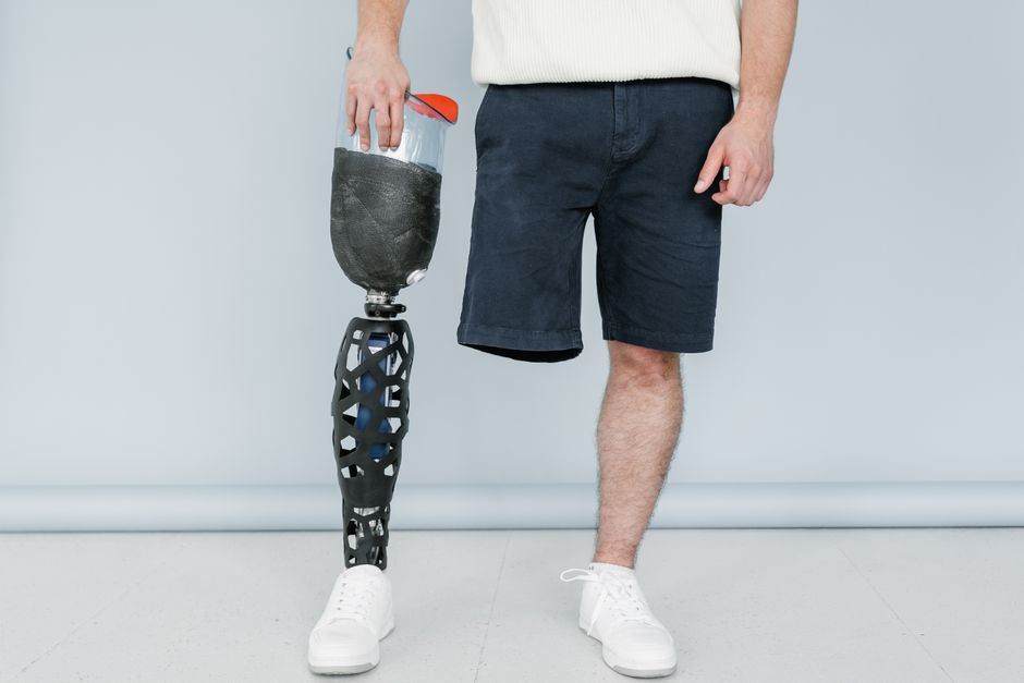 What Amputation Injuries Are Really Worth